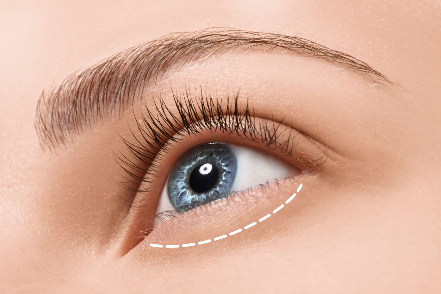 Lower Eyelid Surgery Technique