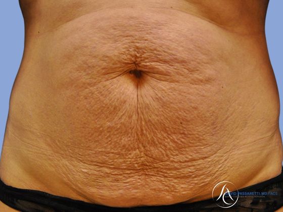 Abdominoplasty Before & After