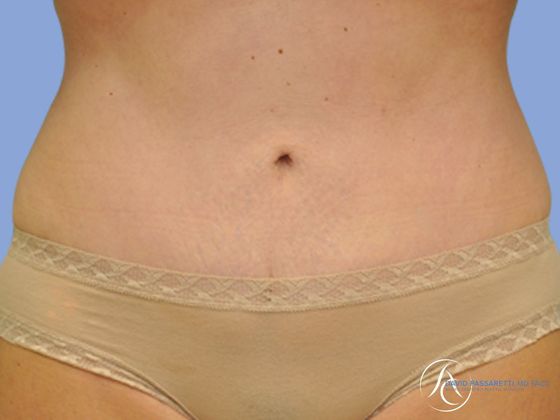 Abdominoplasty Before & After