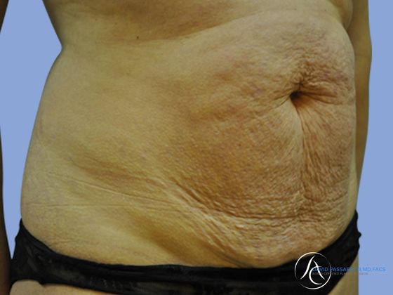 Abdominoplasty Before & After