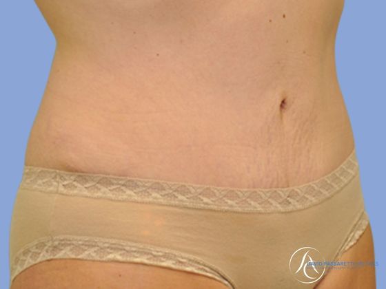 Abdominoplasty Before & After