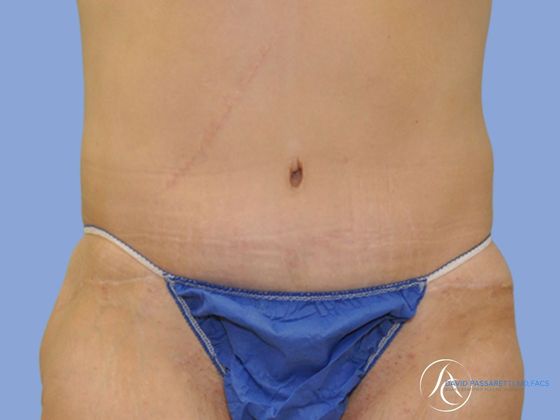 Abdominoplasty Before & After