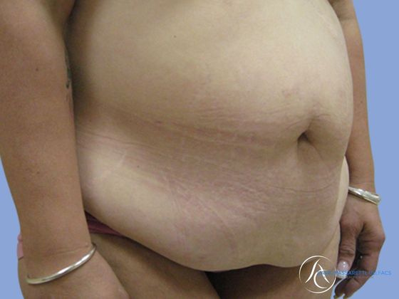 Abdominoplasty Before & After