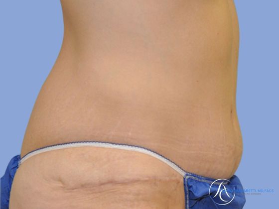 Abdominoplasty Before & After