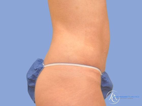 Abdominoplasty Before & After