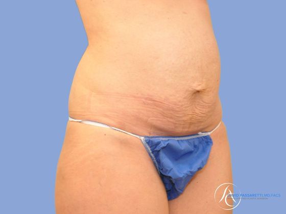 Abdominoplasty Before & After