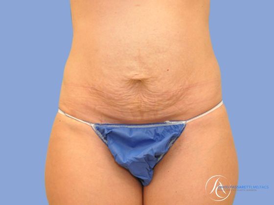 Abdominoplasty Before & After