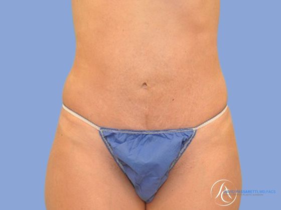 Abdominoplasty Before & After