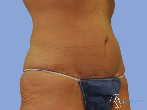 Abdominoplasty Before & After