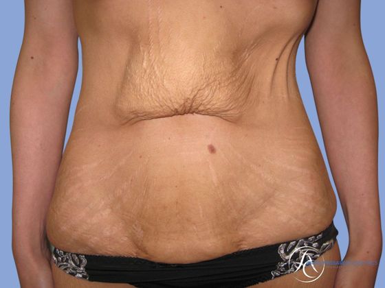 Abdominoplasty Before & After