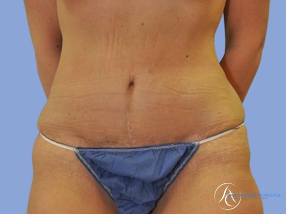 Abdominoplasty Before & After