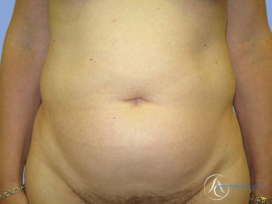 Abdominoplasty Before & After