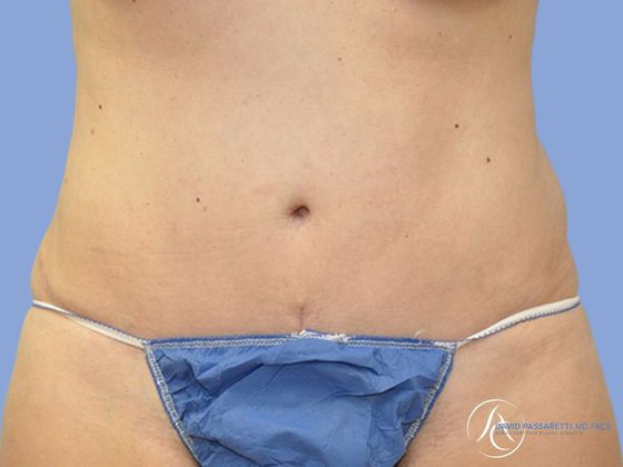 Abdominoplasty Before & After