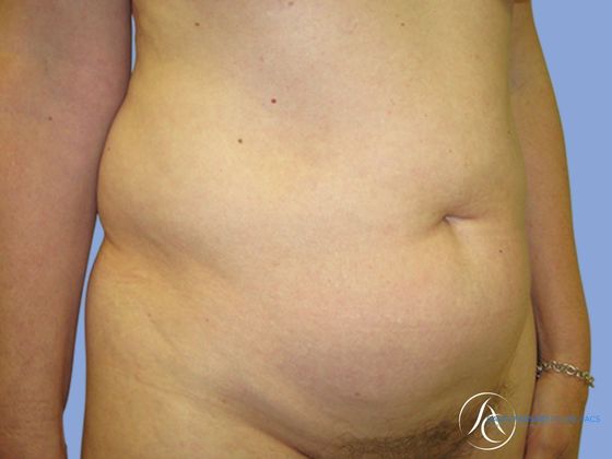 Abdominoplasty Before & After