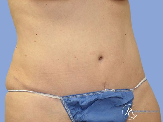 Abdominoplasty Before & After