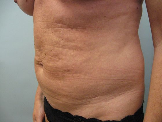 Abdominoplasty Before & After