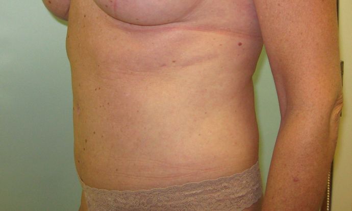 Abdominoplasty Before & After