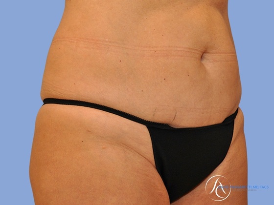 Abdominoplasty Before & After