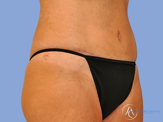 Abdominoplasty Before & After