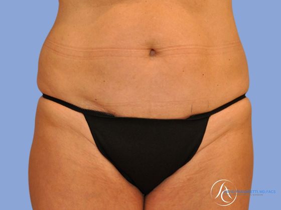 Abdominoplasty Before & After