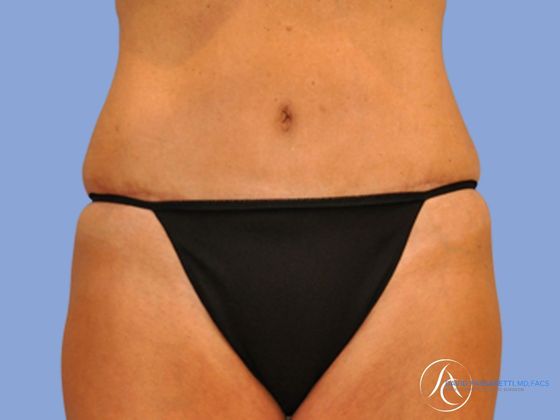 Abdominoplasty Before & After