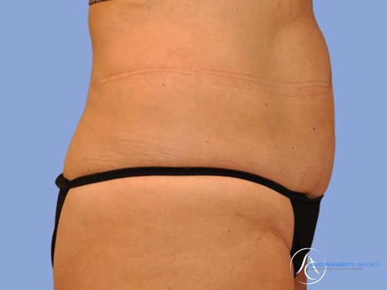 Abdominoplasty Before & After