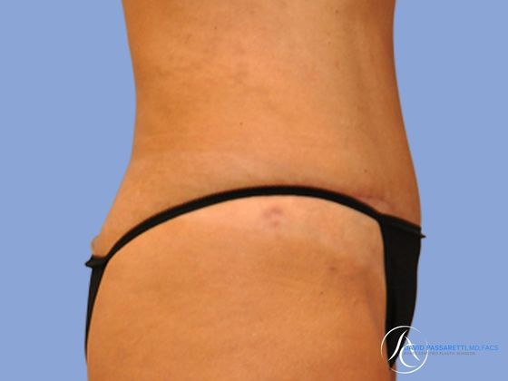 Abdominoplasty Before & After