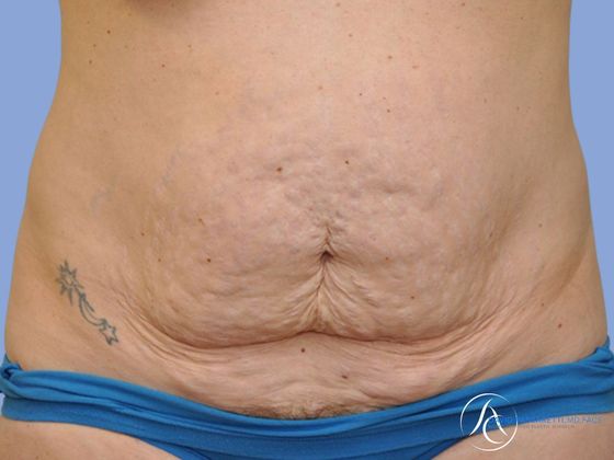 Abdominoplasty Before & After