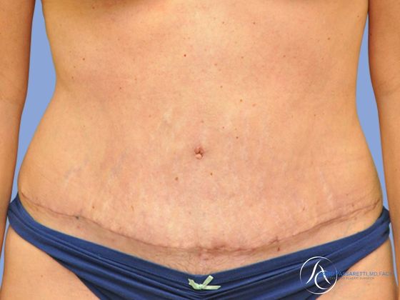 Abdominoplasty Before & After