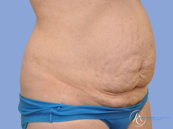 Abdominoplasty Before & After