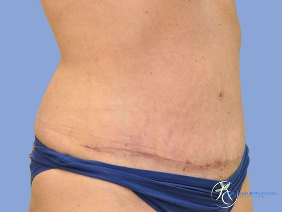 Abdominoplasty Before & After