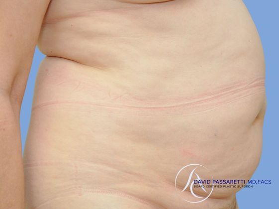 Abdominoplasty Before & After