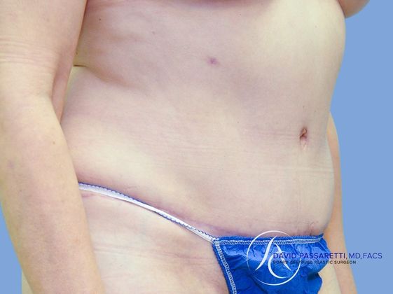 Abdominoplasty Before & After