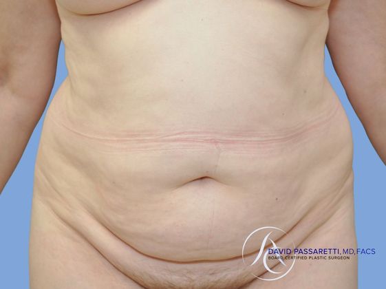 Abdominoplasty Before & After