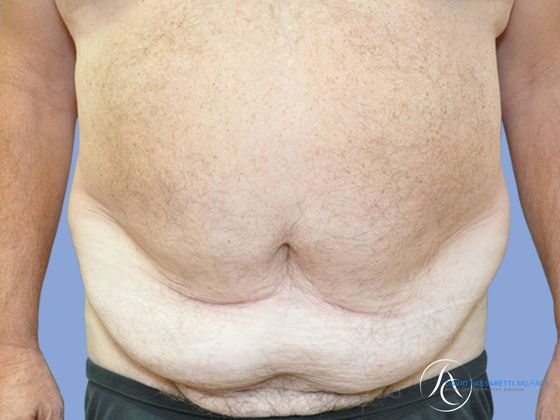 Abdominoplasty Before & After