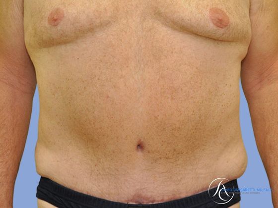 Abdominoplasty Before & After