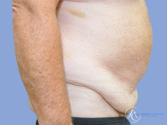 Abdominoplasty Before & After