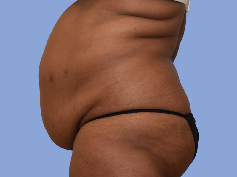 Abdominoplasty Before & After