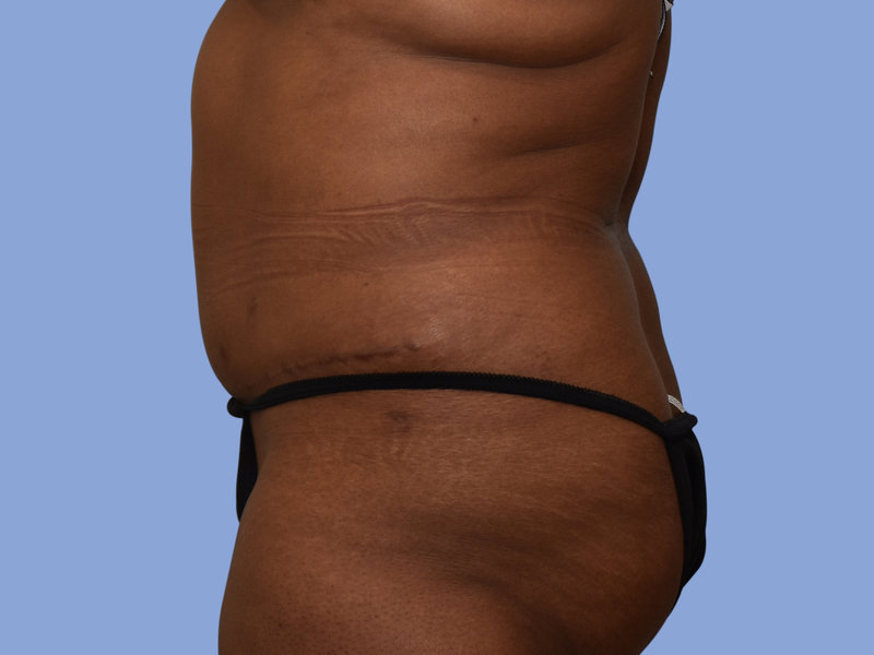 Abdominoplasty Before & After
