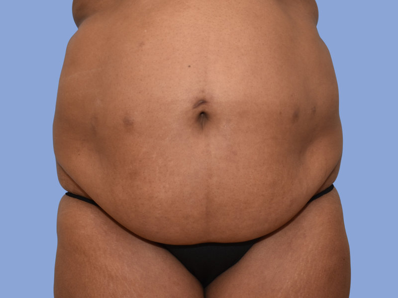 Abdominoplasty Before & After