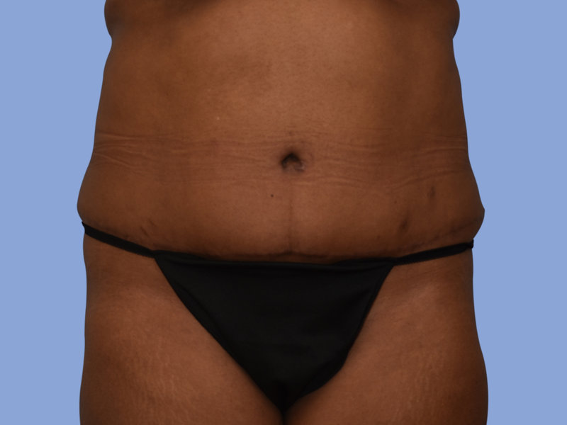 Abdominoplasty Before & After