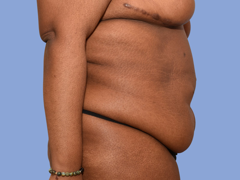 Abdominoplasty Before & After