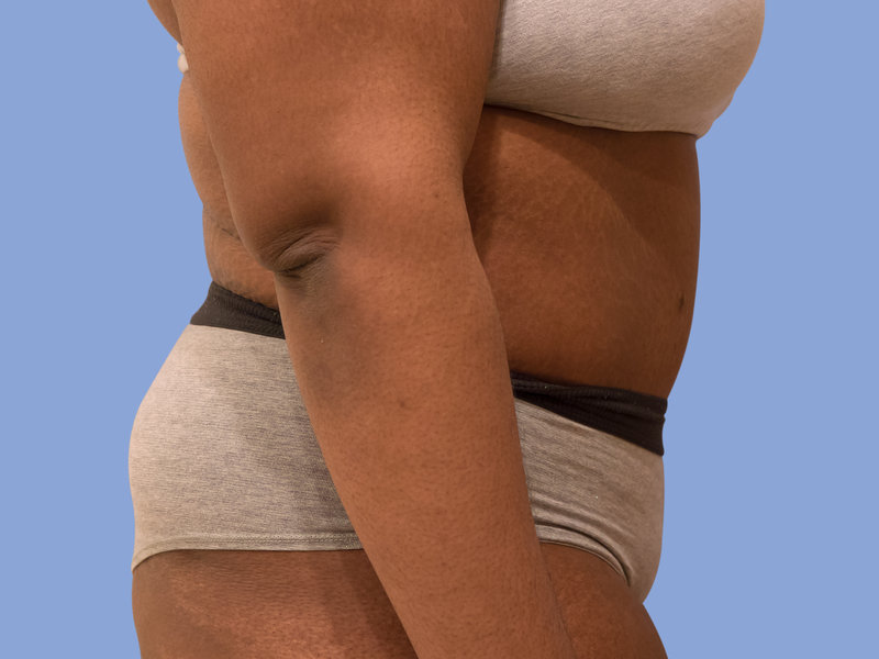 Abdominoplasty Before & After