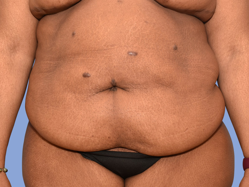 Abdominoplasty Before & After