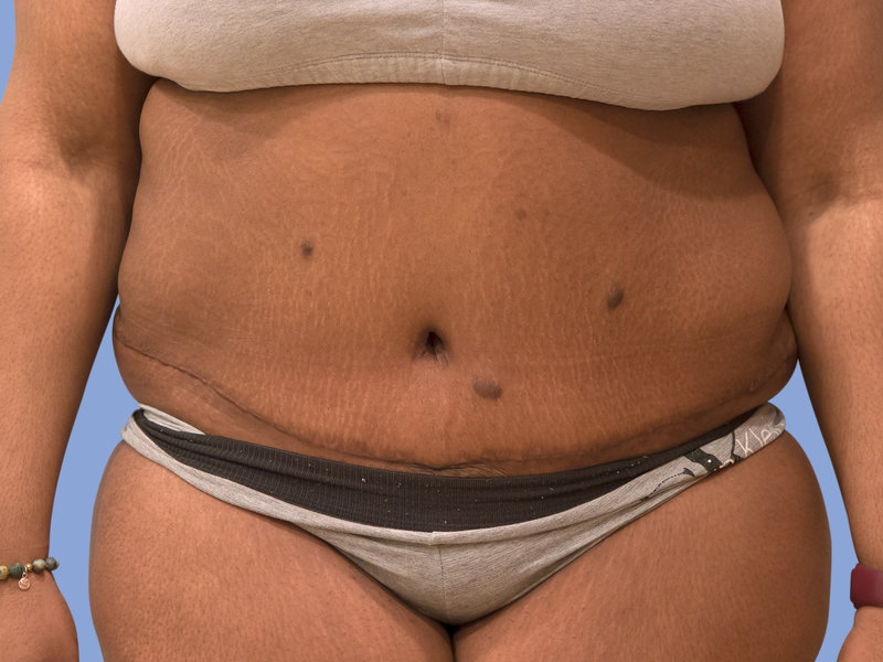 Abdominoplasty Before & After