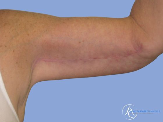 Arm lift Before & After