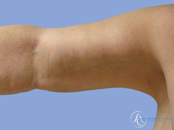 Arm lift Before & After