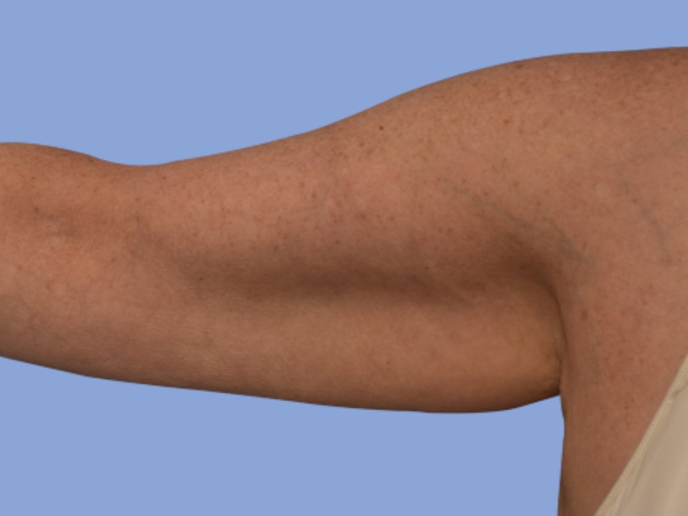Arm lift Before & After