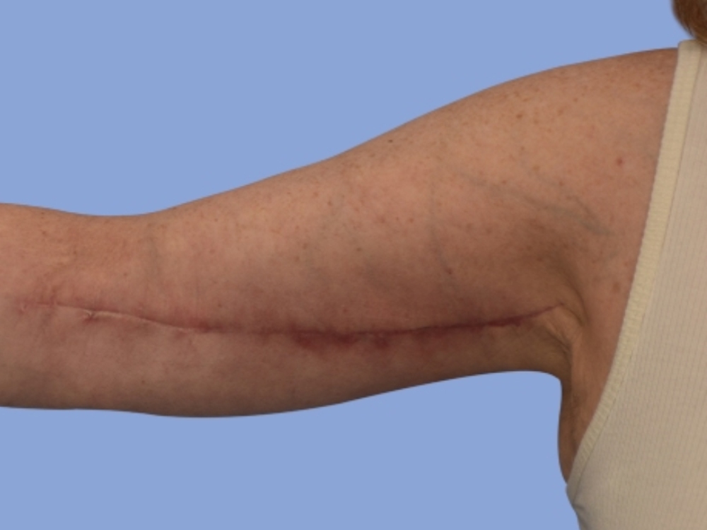 Arm lift Before & After