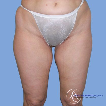 Liposuction Before & After